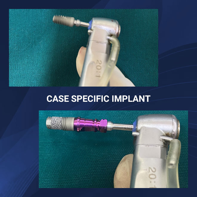 Implants