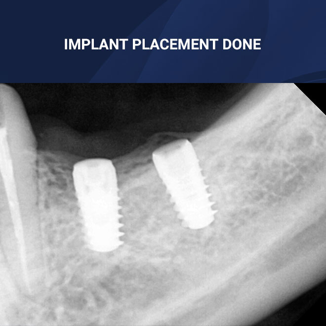 Implants