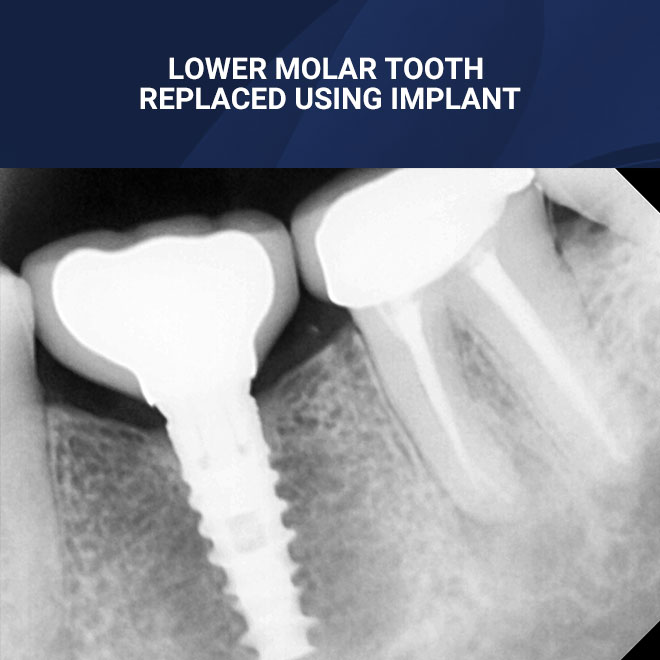 Implants