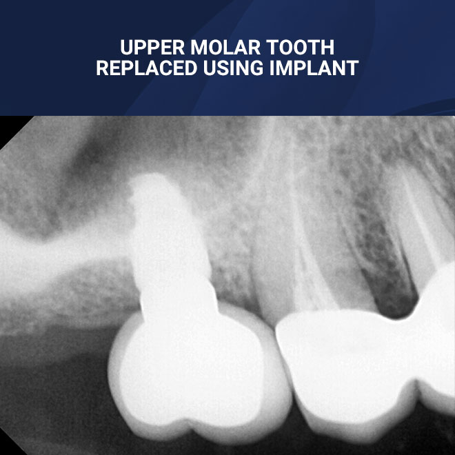 Implants