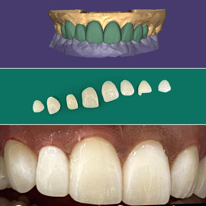 Laminates & Veneers
