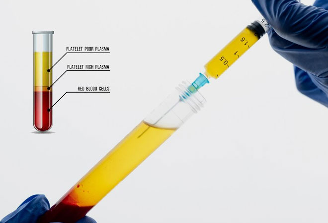 PRP Treatment