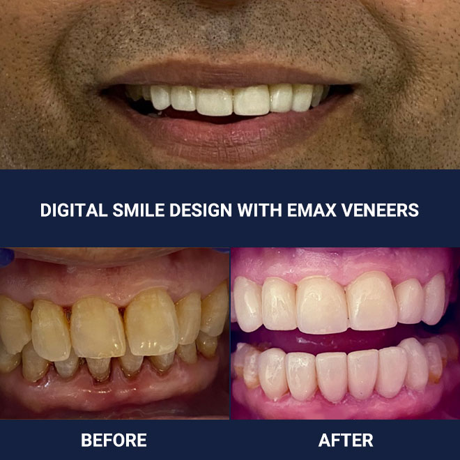 Smile Design