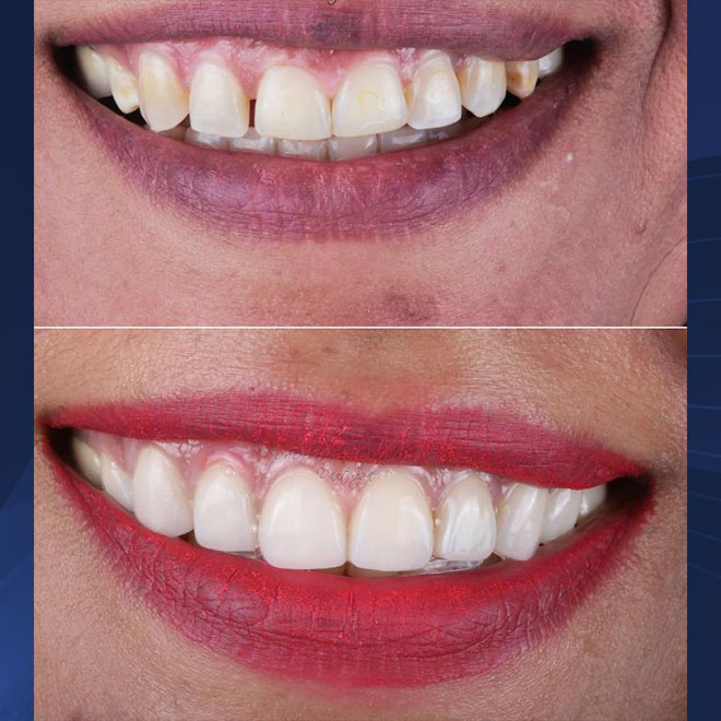 Smile Design