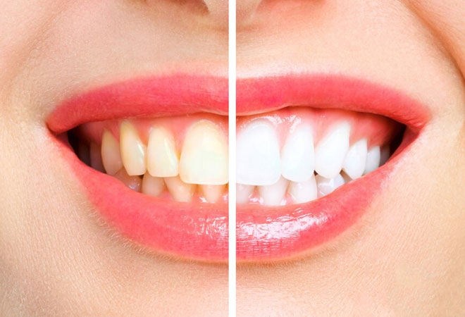 Teeth Whitening