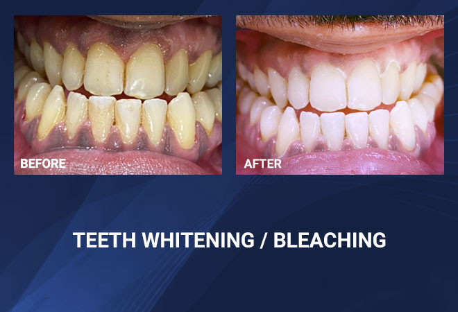 Teeth Whitening